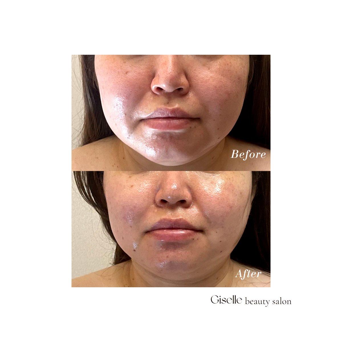 プレミアムケア ビフォーアフター たるみ改善